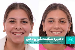 درمان میگرن و لبخند لثه‌ای بدون جراحی